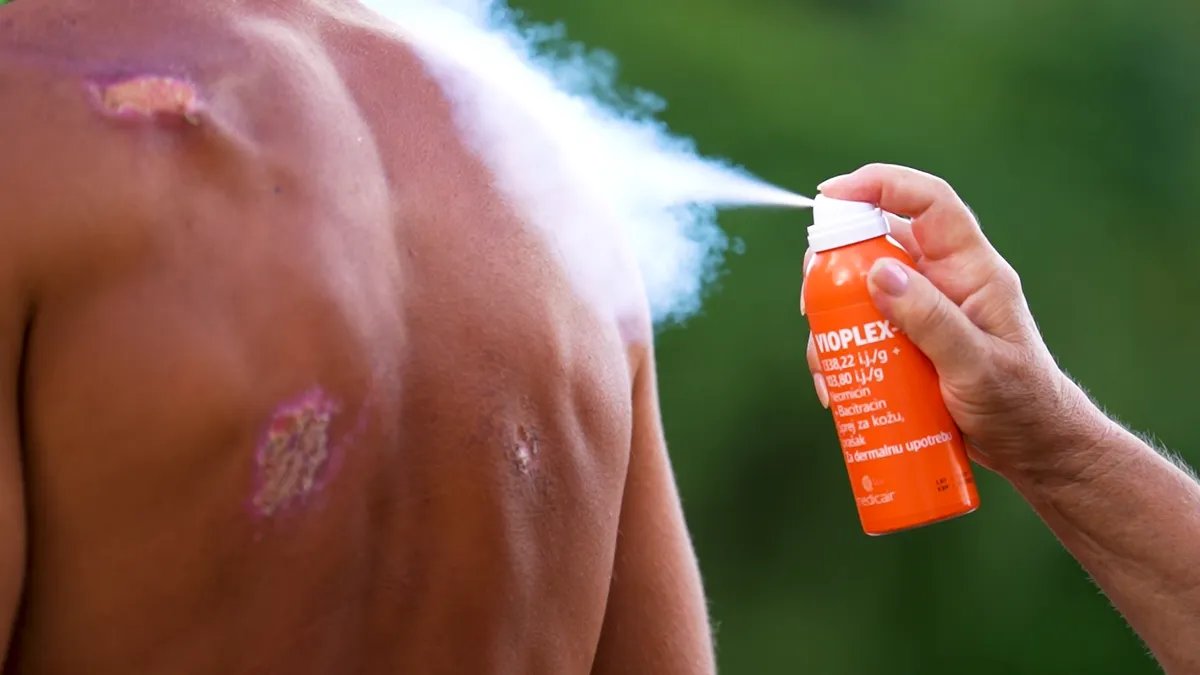 Takmičari Survivor-a posle dva meseca u divljini zadobili bezbroj povreda na telu, a ovako su zalečili sve rane (VIDEO)