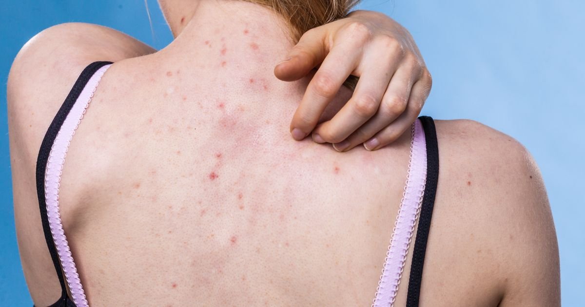 Zašto su akne na leđima toliko tvrdoglave? Ovih 7 promena u rutini daju rezultate već za par nedelja