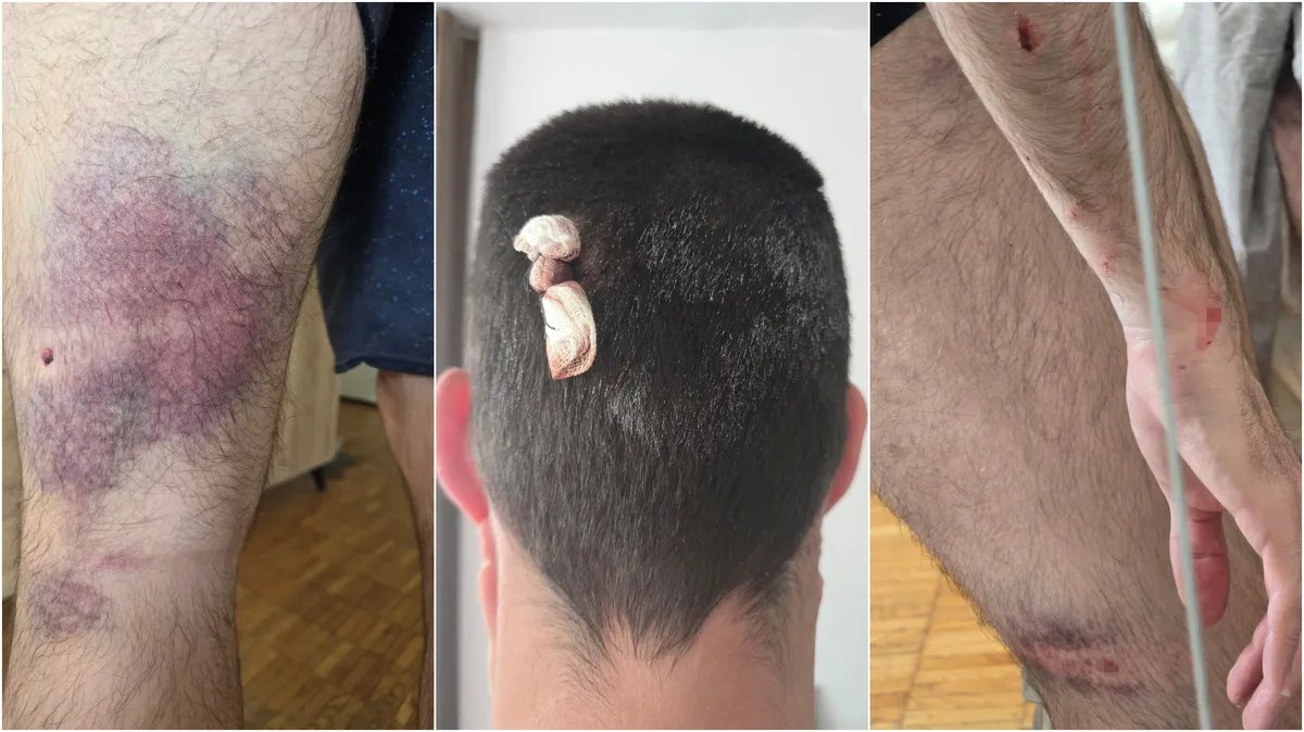 Mladić brutalno pretučen u Beogradu: Muškarci pisali grafite kojim podržavaju SNS vlast, a kad ih je pitao šta to rade, izvukli metalne cevi i prebili ga, napali mu i devojku