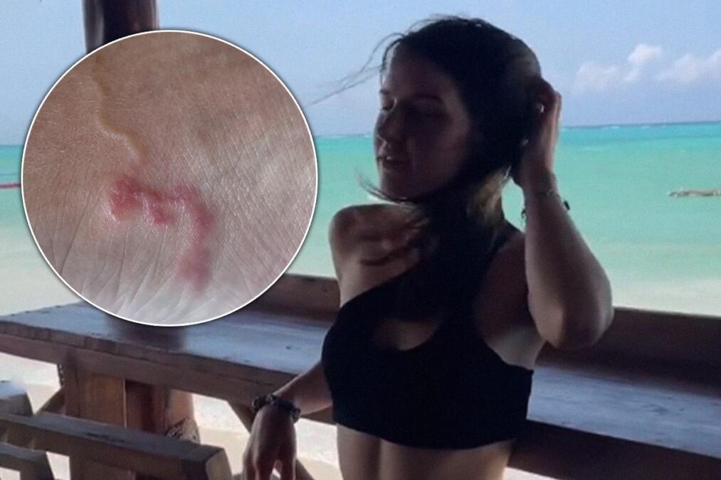 Jovana otišla na odmor iz snova, a vratila se sa živim stanarom u koži koji joj pravi pakao: "Gledala sam kako putuje kroz mene"