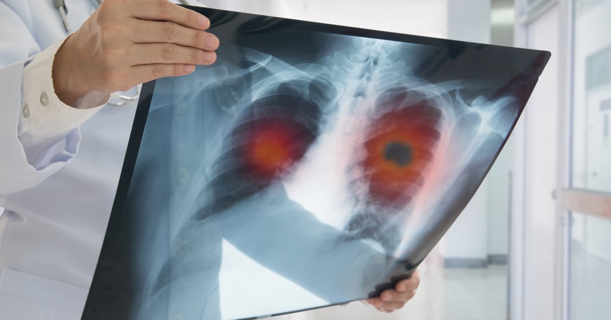 PLUĆA "PUCAJU" KAO KOKICE Ruski lekari definisali nove simptome ove bolesti: Sad je lakše otkrivaju