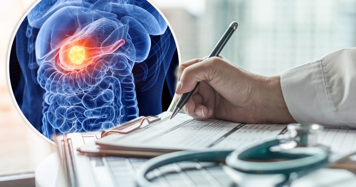 Ovaj karcinom je najopasniji, a simptomi dolaze kasno! Ovu hranu izbegavajte ili smanjite, savetuje naš lekar