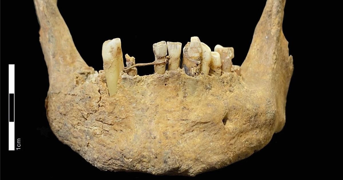 Napravljen je od 20-karatnog zlata i to između 1460. i 1670. godine: Otkriven najstariji zubni most u Škotskoj