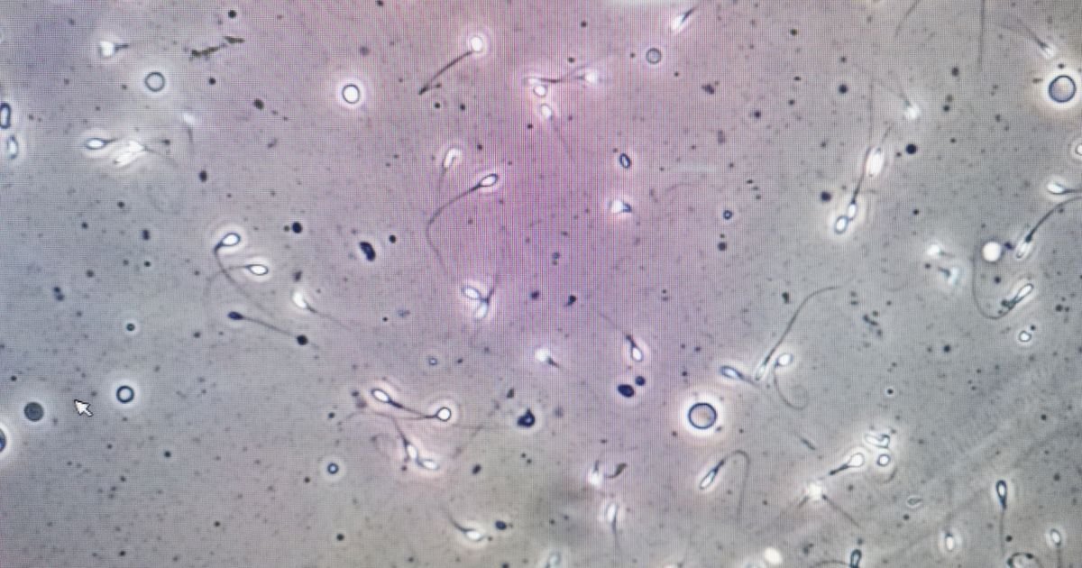 Revolucionarni medicinski poduhvat: Muškarac proizveo spermatozoide iz tkiva zamrznutog kad je bio dete