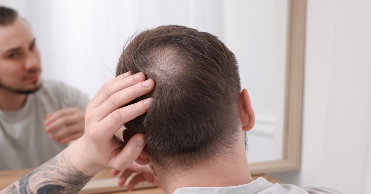 Da li vam se kosa proređuje ili umišljate? Kako da na vreme zaustavite opadanje