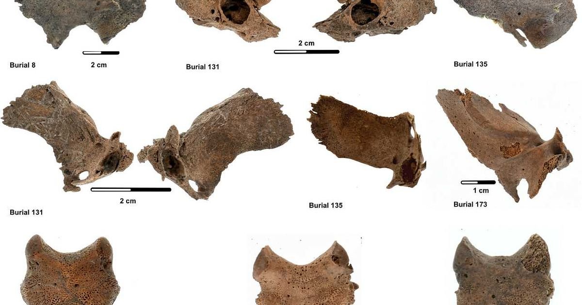 Skorbut na skeletima pronađen na arheološkim lokacijama iz kasnog holocena u Kaliforniji
