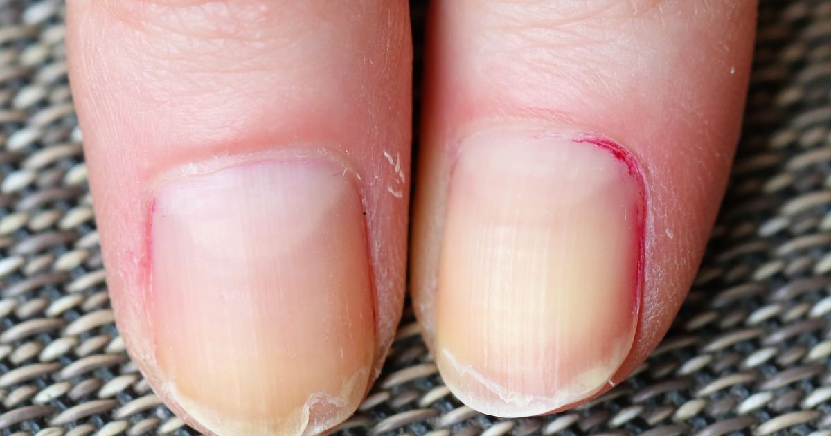 Šta uzrokuje listanje noktiju? Nije samo estetski problem, već signal koji vam šalje telo - evo na šta ukazuje