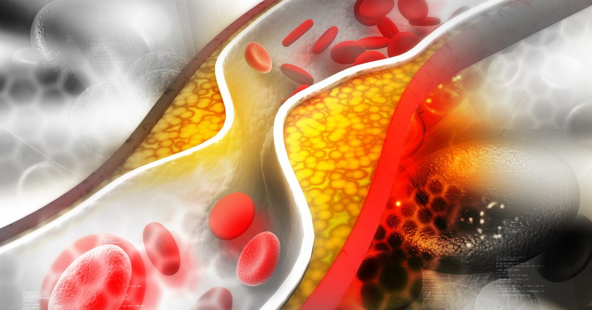 Skriveni neprijatelj krvnih sudova: Zašto lipoprotein(a) predstavlja kardiološki rizik za svakog petog čoveka