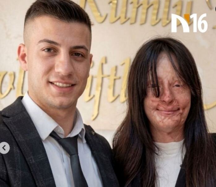 Bivši joj bacio kiselinu u lice, a ona se ipak udala za njega: Sve uradila u tajnosti, otac poludeo kad je čuo