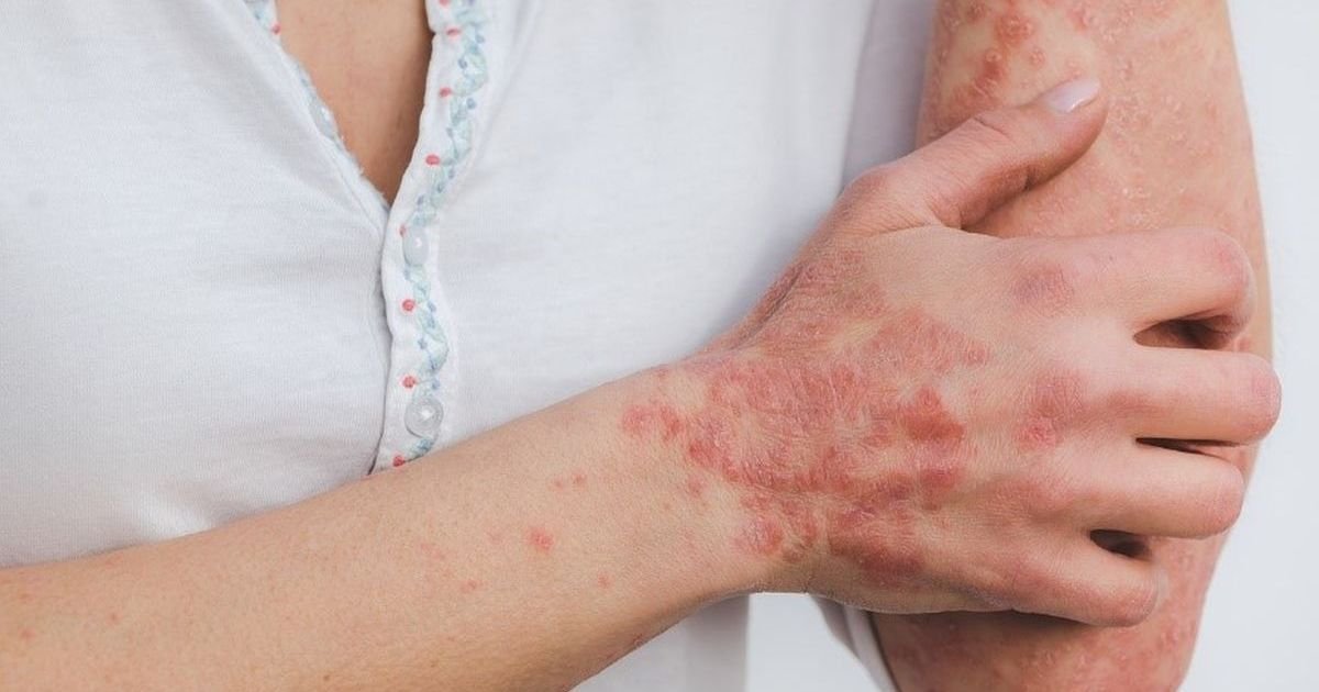 Sunčanje, uz oprez, može da ima pozitivan efekat na psorijazu