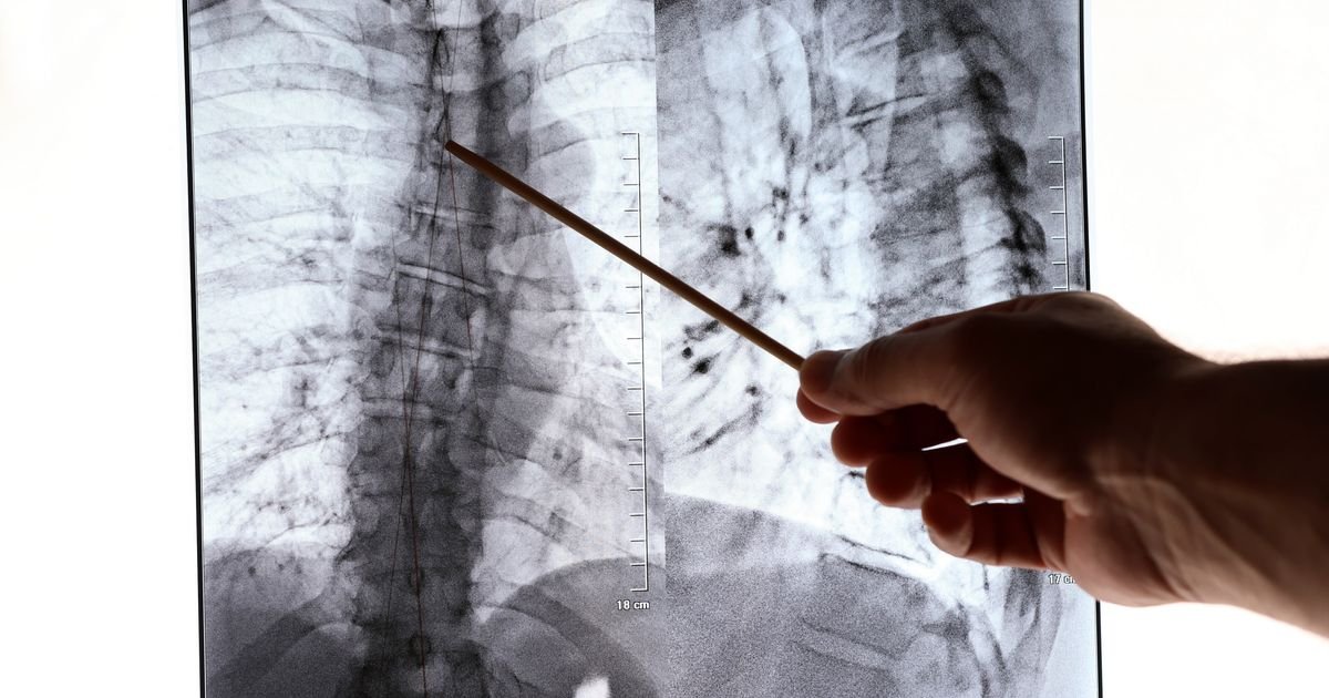 Veliki pomaci u lečenju plućne hipertenzije u Srbiji - dostupne saveremene terapije
