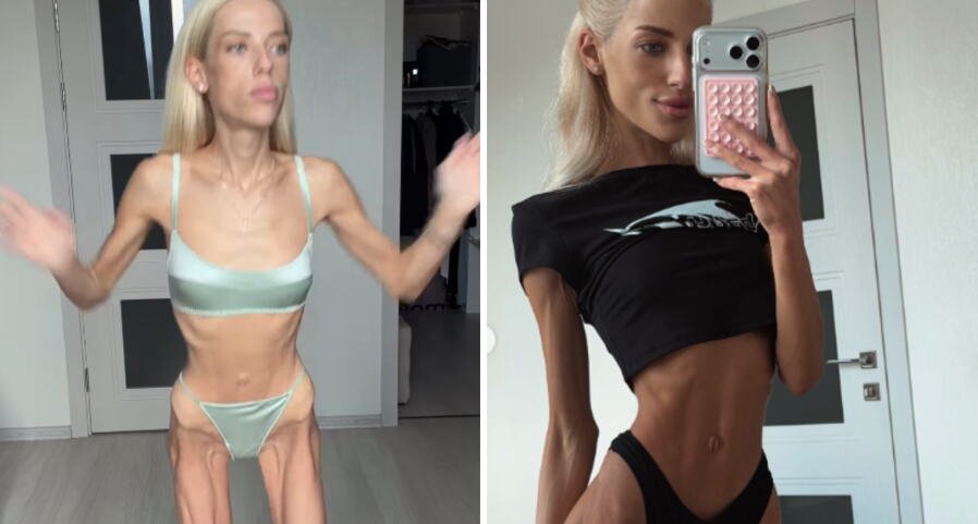 Violeta ima samo 32 kilograma i tvrdi da nije anoreksična: Kaže da redovno ide kod lekara, a evo šta je uzrok njenoj ekstremnoj mršavosti