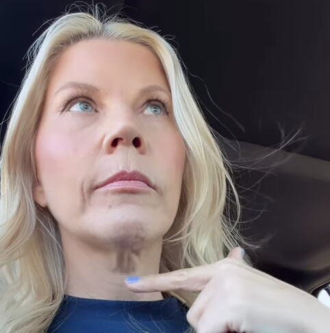 Otišla na zatezanje lica, pa zažalila pet meseci kasnije: "Razočarana sam, nisam bila svesna..." (foto/video)